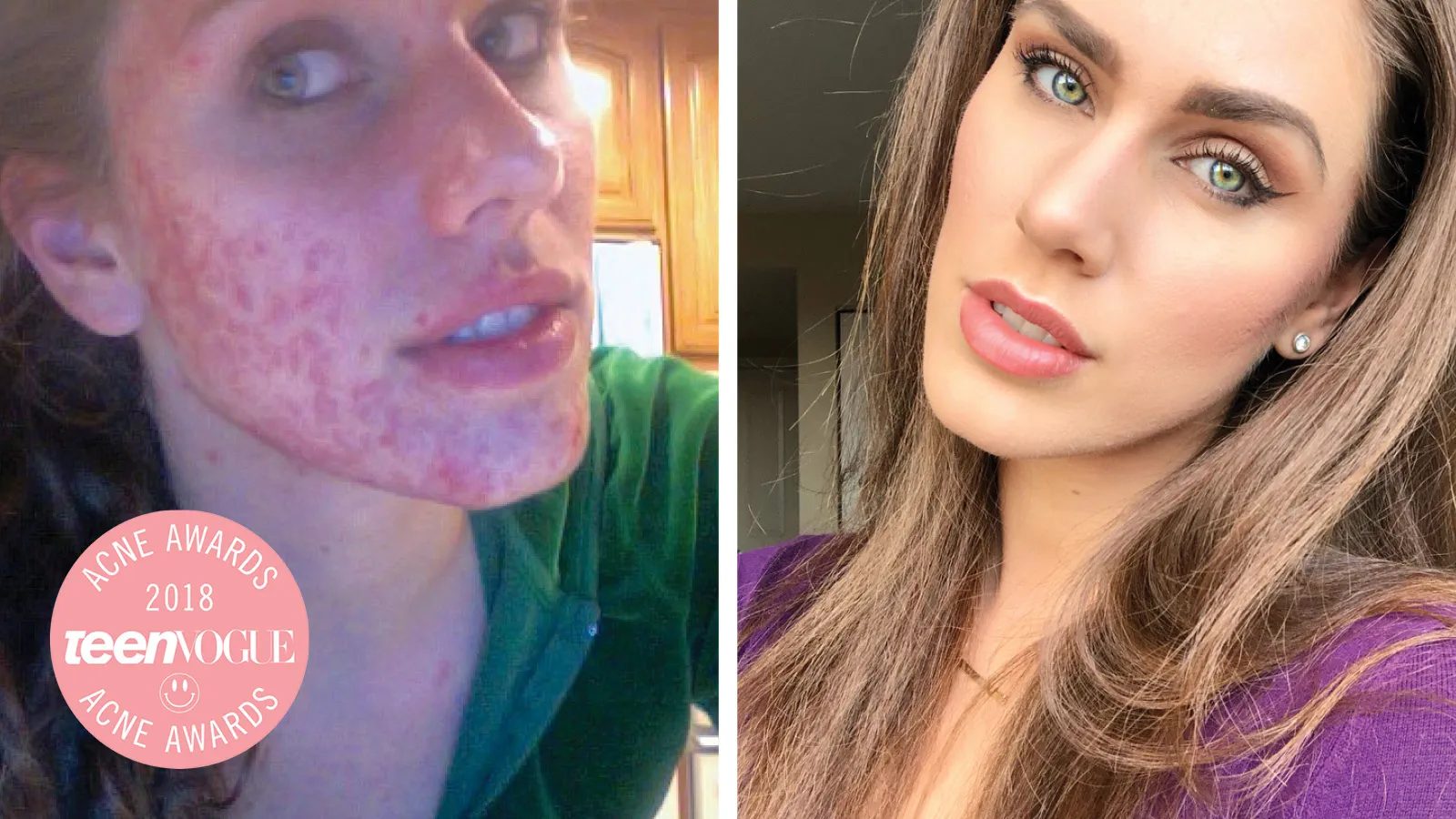 Cassandra Bankson featured by Allure and Teen Vogue for acne advocacy