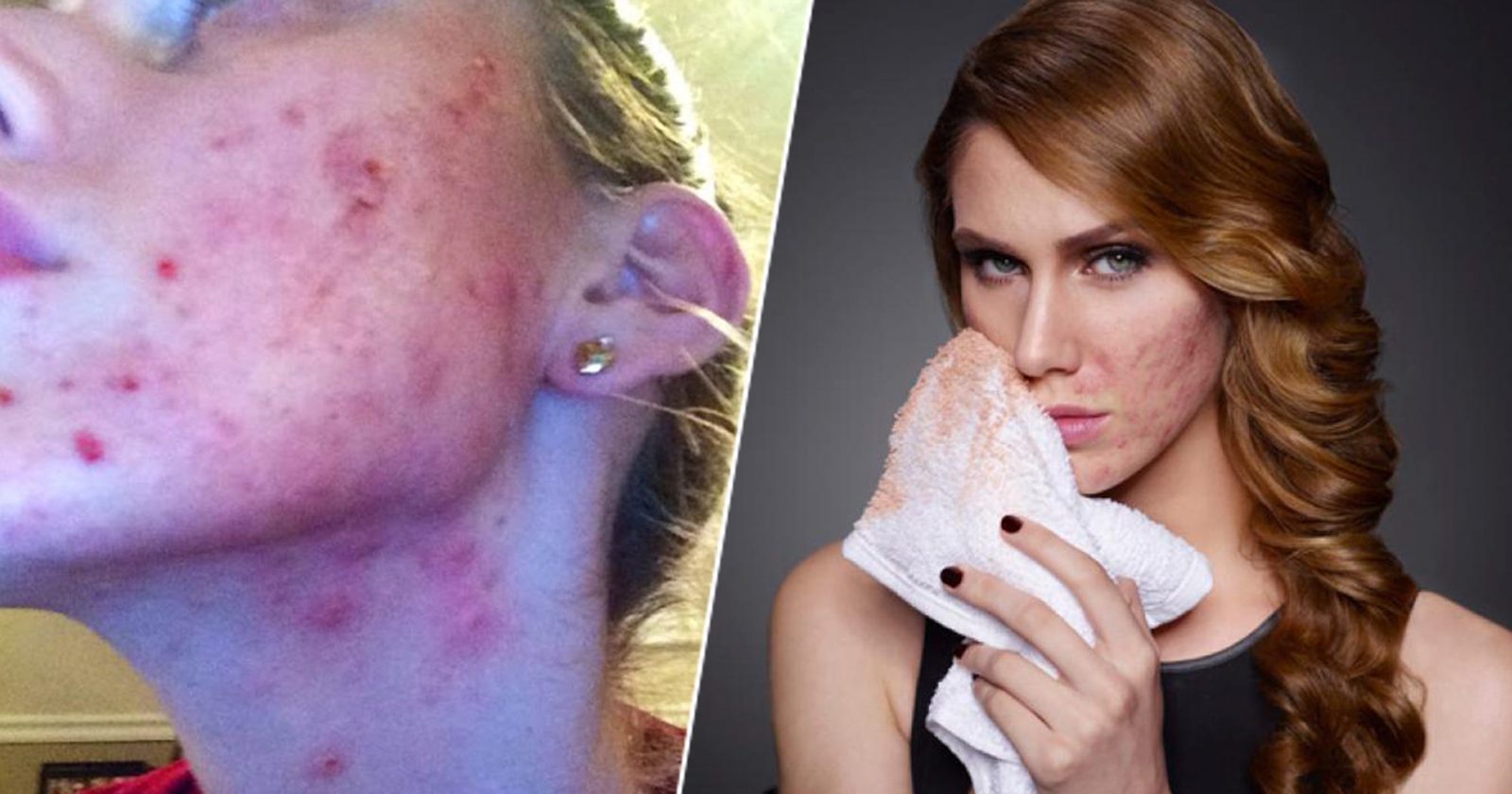 Cassandra Bankson real acne transformation, the story behind her skincare authority
